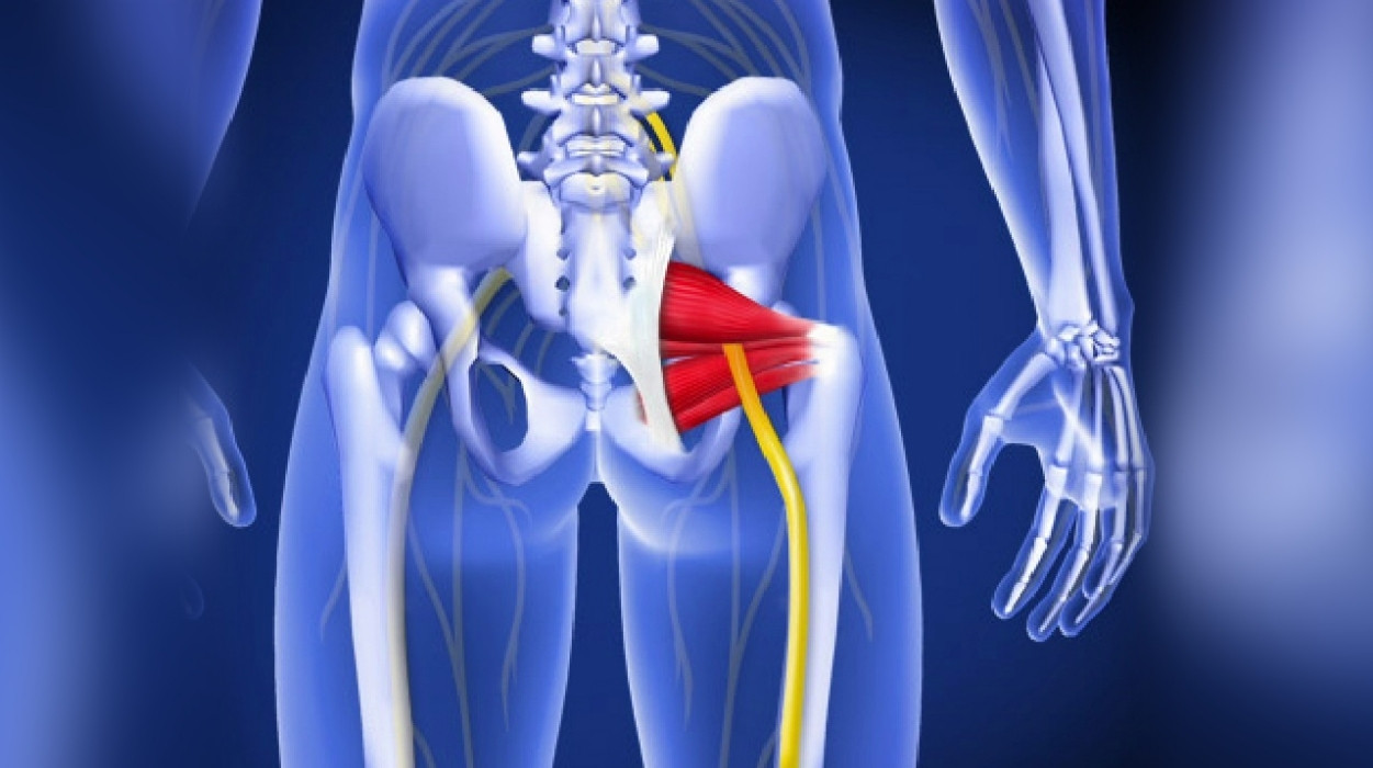 Fluoroscopic Guided Piriformis Injection Omaha, NE